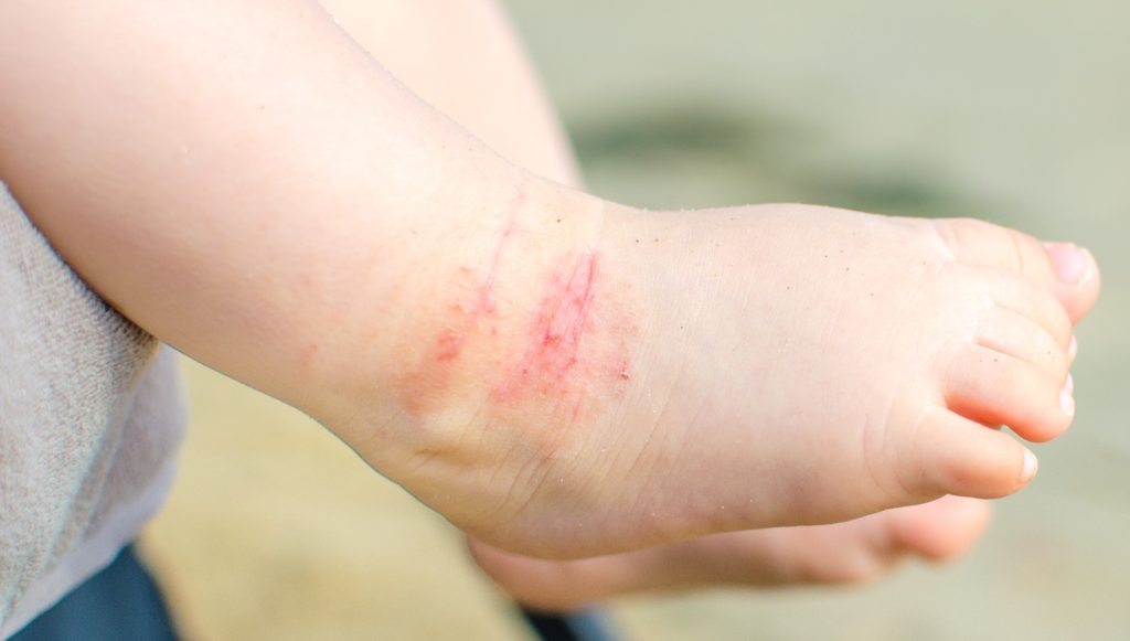 Canva - itchy dermatitis atopic baby foot
